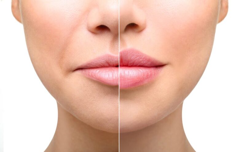 Lip Injections in Scottsdale: Enhancing Your Beauty with Precision