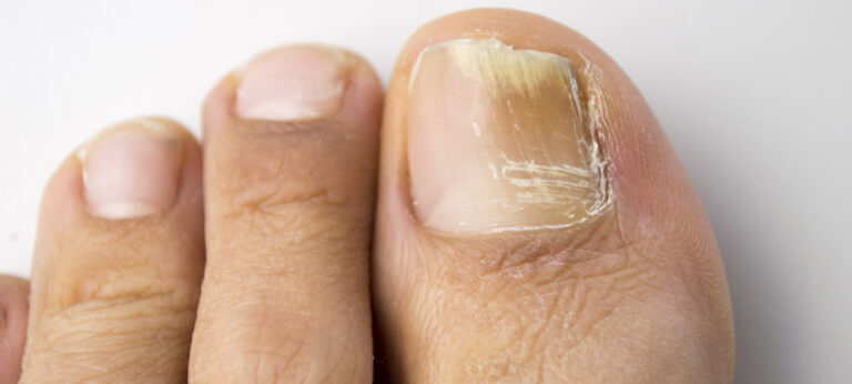 Toenail Fungus Remedy: Natural Solutions for Healthy and Beautiful Nails